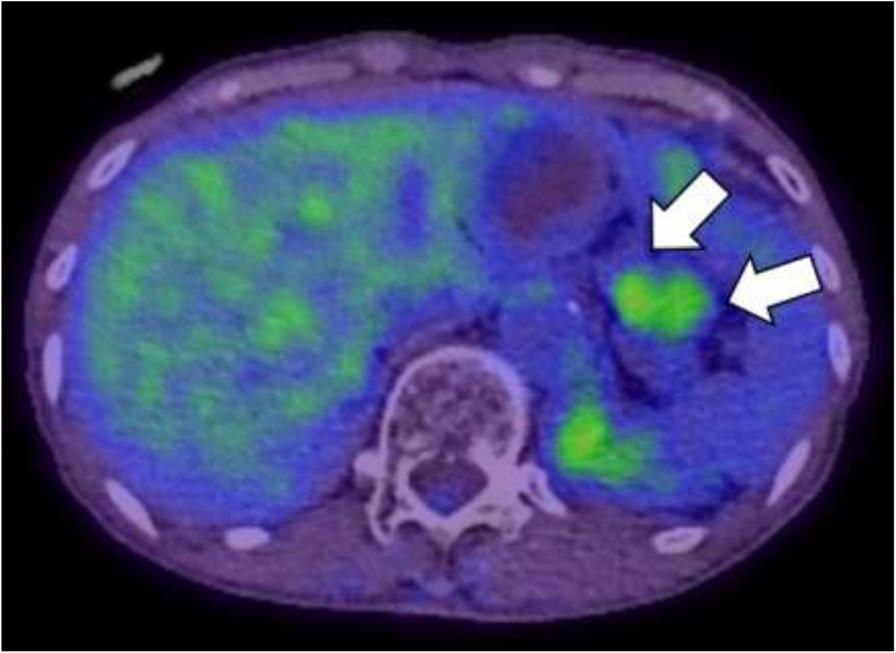 Koizumi et al. BMC Cancer (2019) 19:320 Fig. 4 Positron emission tomography/computed tomography findings.