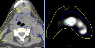 03 unsuspected superior mediastinal disease on PET 12 2.33 1.13 1.19 larger tumor mass on PET than identified on CT 13 0.92 1 1 atalectasis identified inarea suspicious for tumor on CT 14 9.57 1.08 1.