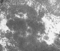 Anatomic Pathology / ORIGINAL ARTICLE Image 3 (Case 3) Transmission electron microscopy of amorphous material ( 45,000) showing dense osmiophilic deposits without fibrils in the extracellular matrix.