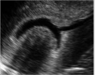 According to the yellow line a. Thickened endometrium b. Absent posterior sliding sign of the uterus c. Poorly defined junctional zone d. Asymmetrically enlarged uterus e.