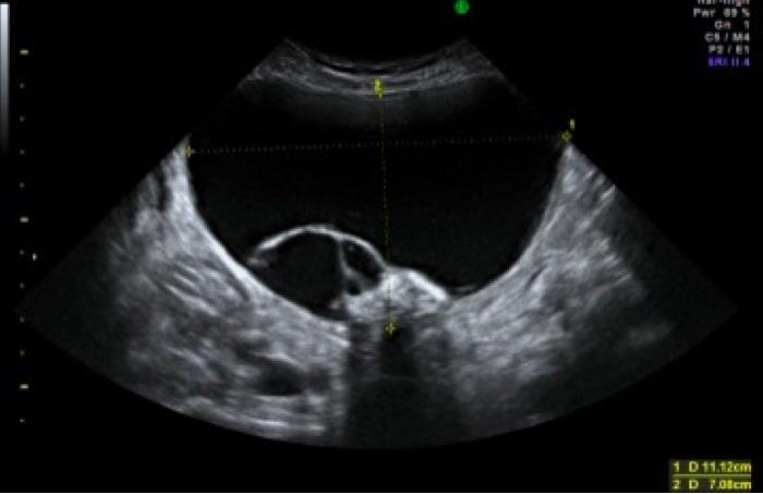 functional ovarian cyst?