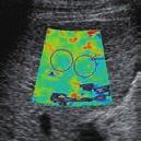 The image appears significantly more yellowish than in case 2 (Fig. 10). Red areas are also observed, clearly indicating stiff tissues.