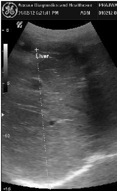 7 JEST-M, Vol 3, Issue 1, 2014 One ROI in the near-field (located at the bottom of subcutaneous fat), and the other ROI in the far-field (located at the top of the liver capsule)ultrasound Images