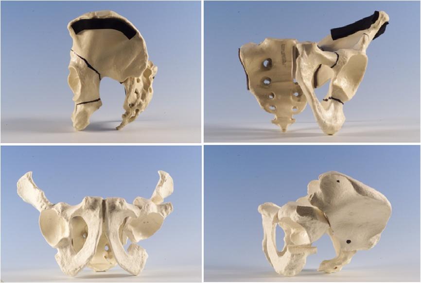 Liddell and Prosser Journal of Orthopaedic Surgery and Research 2013, 8:17 Page 3 of 6 Figure 1 Three dimensional