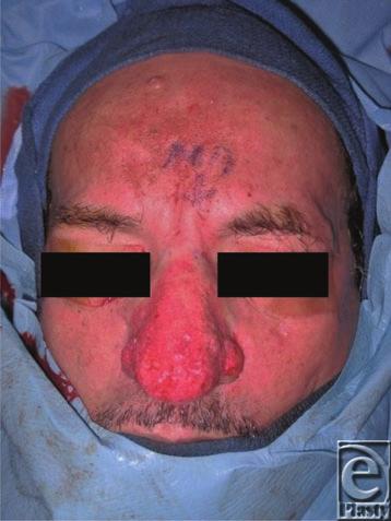 Figure 3. Improved cosmetic appearance after tangential excision.