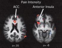 Neuroscience, April 6, 2011 Pain decreased after learning to meditate Pain