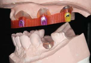 Substructure bar tried in the mouth proceeding by duplicating the immediate denture and fabricating a radiographic guide based on the immediate denture s tooth arrangement.