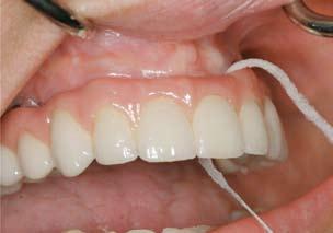Occlusal harmony should improve the load distribution and reduce component failure. A mutually protected occlusal scheme was achieved in the provisional stage.