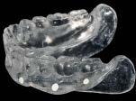 The provisional dentures (Fig 2) were fully milled (including both the denture base and teeth) using a proprietary technique.