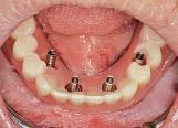 10). The temporary coping screws were then loosened and the prosthesis was removed from the mouth.