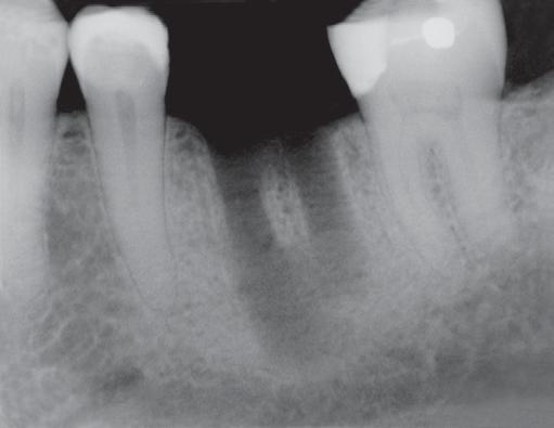Clinical Example The following case report serves to showcase the advantages and flexibility of the Open Platform Inclusive Tooth Replacement Solution.
