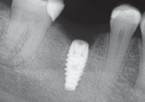 Figure 14: Radiograph of NobelActive implant placed in edentulous site #19 Figure 15: Digital design of custom healing abutment Figure 16: Digital design of custom impression coping Figure 17: Milled