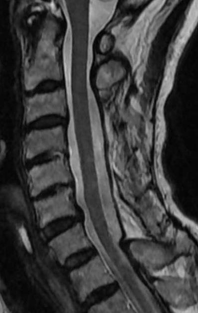 5.Postoperative spinal cord alignment