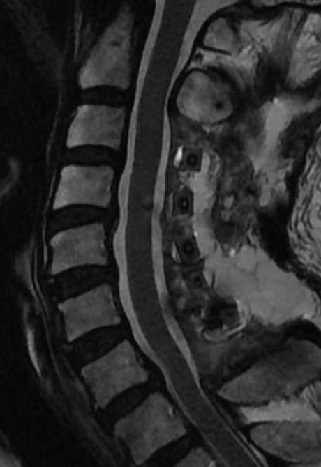 the spinal cord between at C2 and at C7