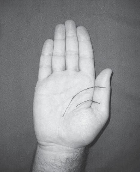 ative clinical length of all fingers has been reported in the literature. We performed this study to assess the clinical relative lengths of the fingers of the human hand by using surface landmarks.