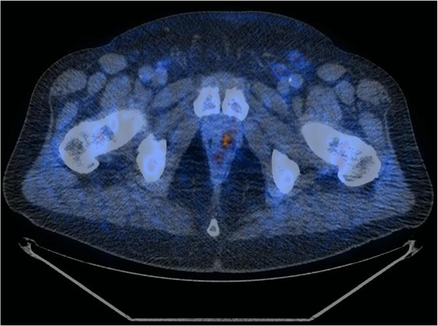 Matti et al. European Journal of Hybrid Imaging (2017) 1:5 Fig. 1 True positive case (PET/CT axial scan).