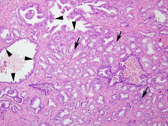 What is Prostate Adenocarcinoma-Histology