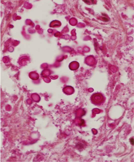 yeast-forms in cystic like space consistent with cryptococcal organisms. The capsule of the yeast-form organisms stained magenta red (mucicarmine stain).