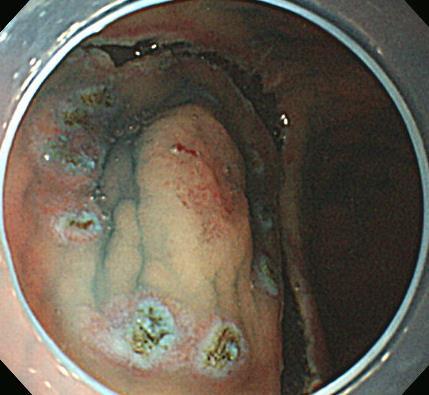 ESD using needle knife (2009) ESD: Early gastric carcinoma : -