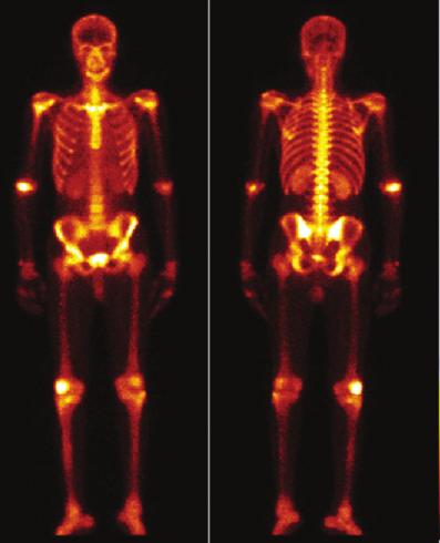 Unmasking Immune Reconstitution Inflammatory Syndrome (IRIS) Figure 1: Three -phase bone scintigraphy delayed images show increased radiotracer uptake in right elbow and knee. RNA copies/ml.