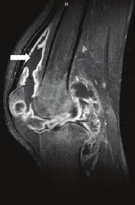 2, respectively]. Multifocal septic arthritis of the right elbow and knee joints with osteomyelitis was diagnosed. The right elbow and knee joints were aspirated and drained thick greenish pus.