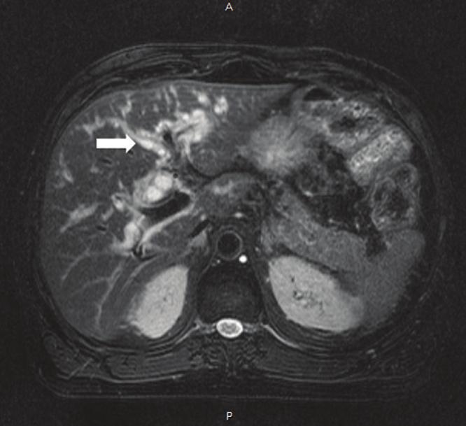 Figure 3: Frontal radiograph chest showing bilateral reticular opacities mainly in mid and lower lungs.