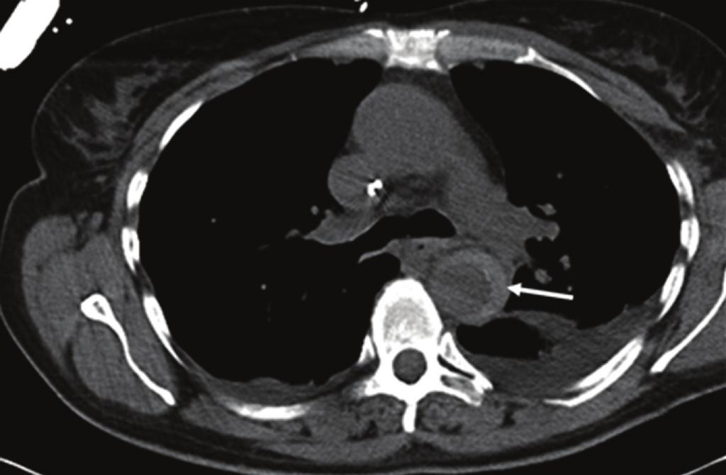 2 Case Reports in Medicine Figure 1: Nonenhanced CT depicting intramural hematoma (arrow). Sagittal reconstruction of CT-angiography (CTA) with penetrating ulcer (arrow).