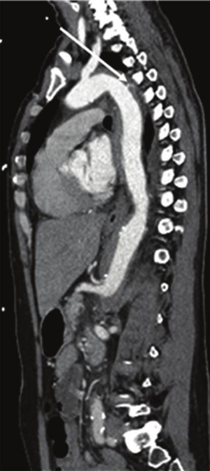 depicted a newly developed circumscribed dissection of the thoracoabdominal aorta which extended almost to the celiac trunk (Figure 3) with broad communication between true and false lumina (Figure