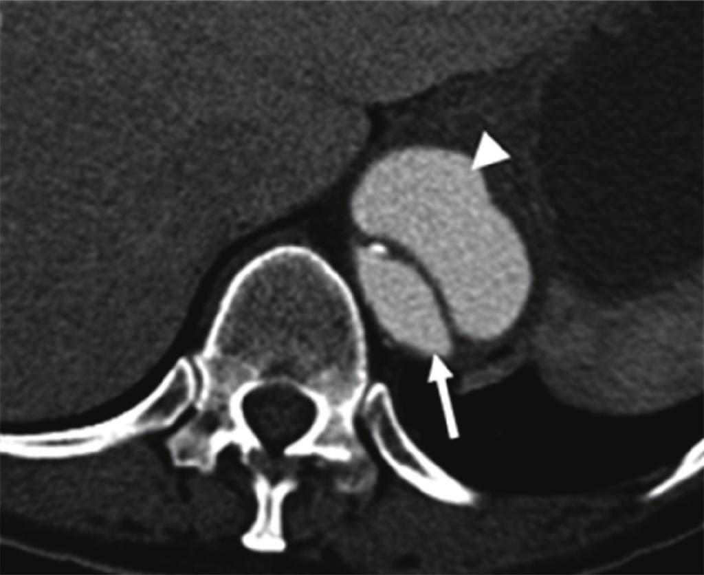 Case Reports in Medicine 3 (c) Figure 3: CTA after three weeks after first intervention shows a newly developed dissection extending to the celiac trunk (arrow: true lumen and arrowhead: false lumen).