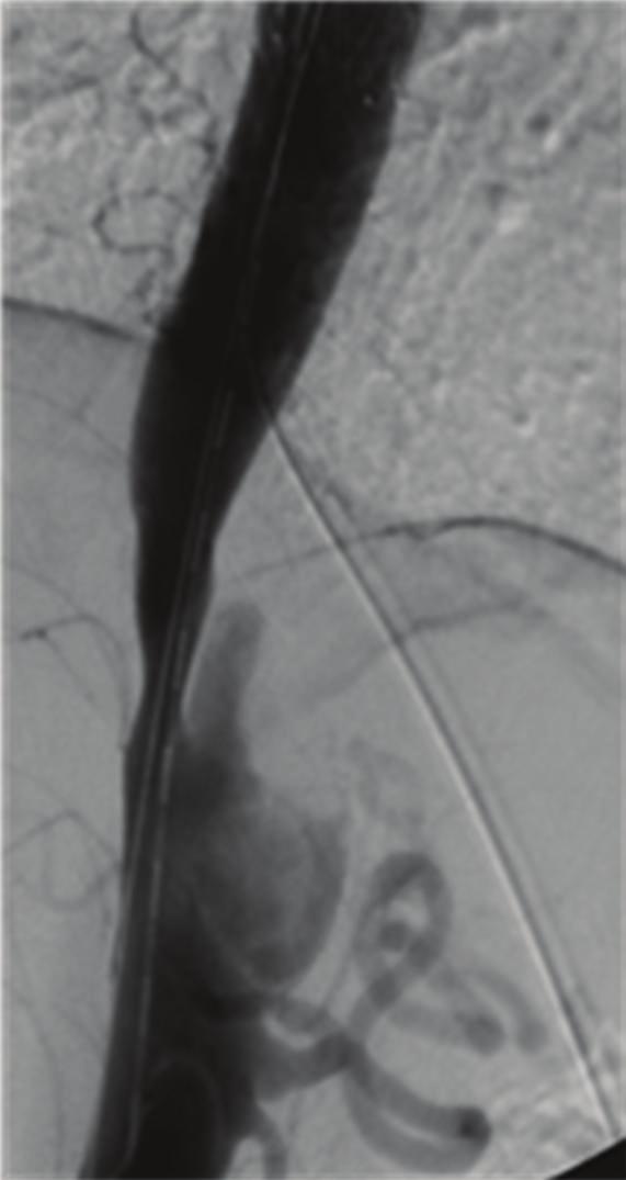 overstenting the left subclavian artery without any clinical consequences. The circumscribed thoracoabdominal dissection had to be treated as well due to progression.