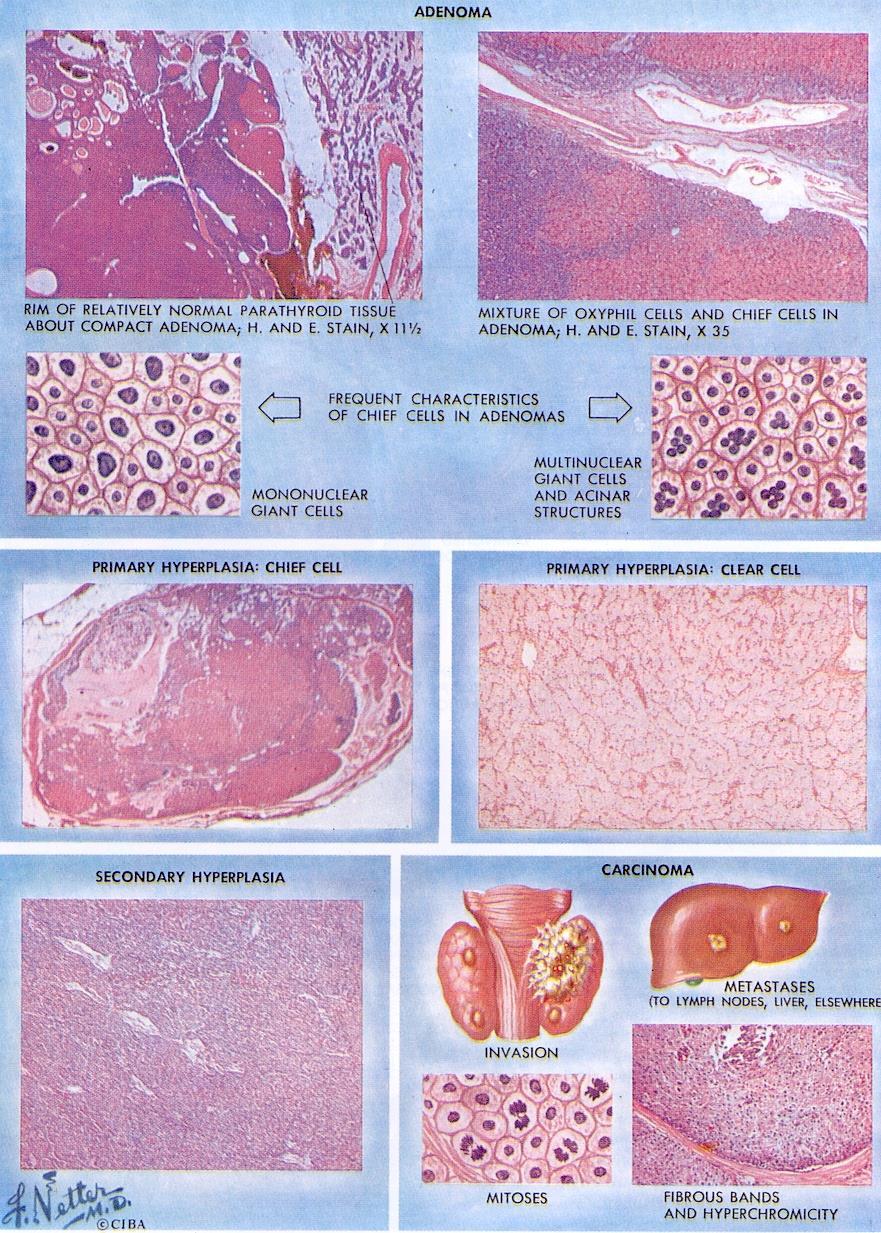 부갑상샘기능항진증조직학적변화 1. Adenoma 2. Primary hyperplasia: Chief cell 3.