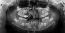 On the contrary, the maxillary right permanent central incisor did not erupt and was still rotated.