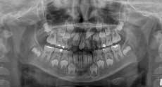 2. Case Ⅱ A 5-year-old boy was presented with the failure of eruption of the maxillary permanent central incisors.