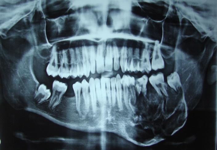 CASE REPORT 1 A male patient aged 20 years reported to our maxillofacial unit with the complaint of swelling in relation to lower back teeth around 3-4 years back.