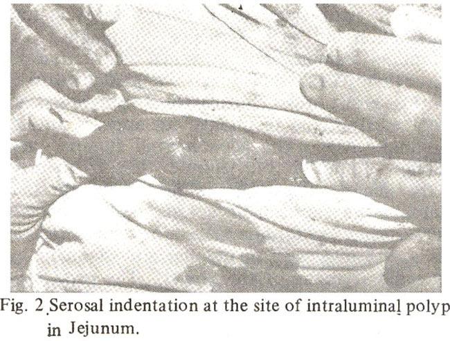 There were at least seven polyps in the proximal jejunum. No polypswere detected in the distal ileum and the large gut.