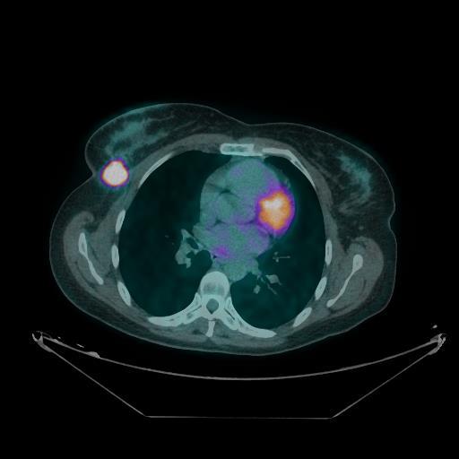 FDG PET/CT showed right BC with axillary nodal (Level