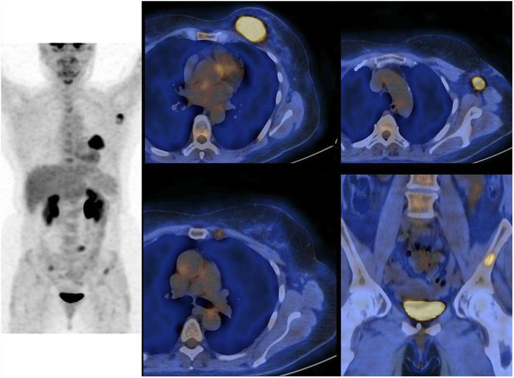 Invasive carcinoma of left breast classified as T3N2M0 (stage IIIA) before PET imaging in 62-y-old
