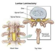 Acromial (point of shoulder) 4. Proximal (closer to the trunk) 4. Vertebral (spinal) MEDICAL TERMINOLOGY 1. lamin-: lamina*; -ectomy: removal; REMOVAL OF LAMINA 5.