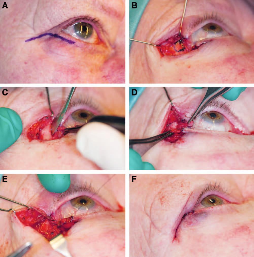 PRS GO 2014 Fig. 2. Intraoperative photographs showing the technique for the lateral periosteal flap canthoplasty. A, Planning of a subciliary incision extended laterally in Borges s lines.