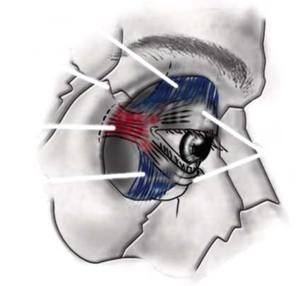 The lateral canthal tendon restricts access to the frontozygomatic suture through the transconjunctival approach.