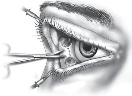 Superior tarsus Inferior tarsus Conjunctival incision Figure 12. The retrocanthal extension of the transconjunctival incision preserves the lateral canthal tendon. Figure 13.
