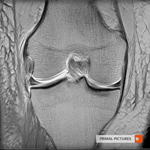 Lateral meniscus Medial meniscus Anterior and posterior cruciate