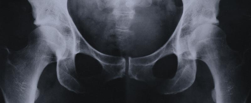 Clinical results After more than 40 years of clinical use in total hip replacements a large number of long-term clinical reports are available for BIOLOX ceramic.