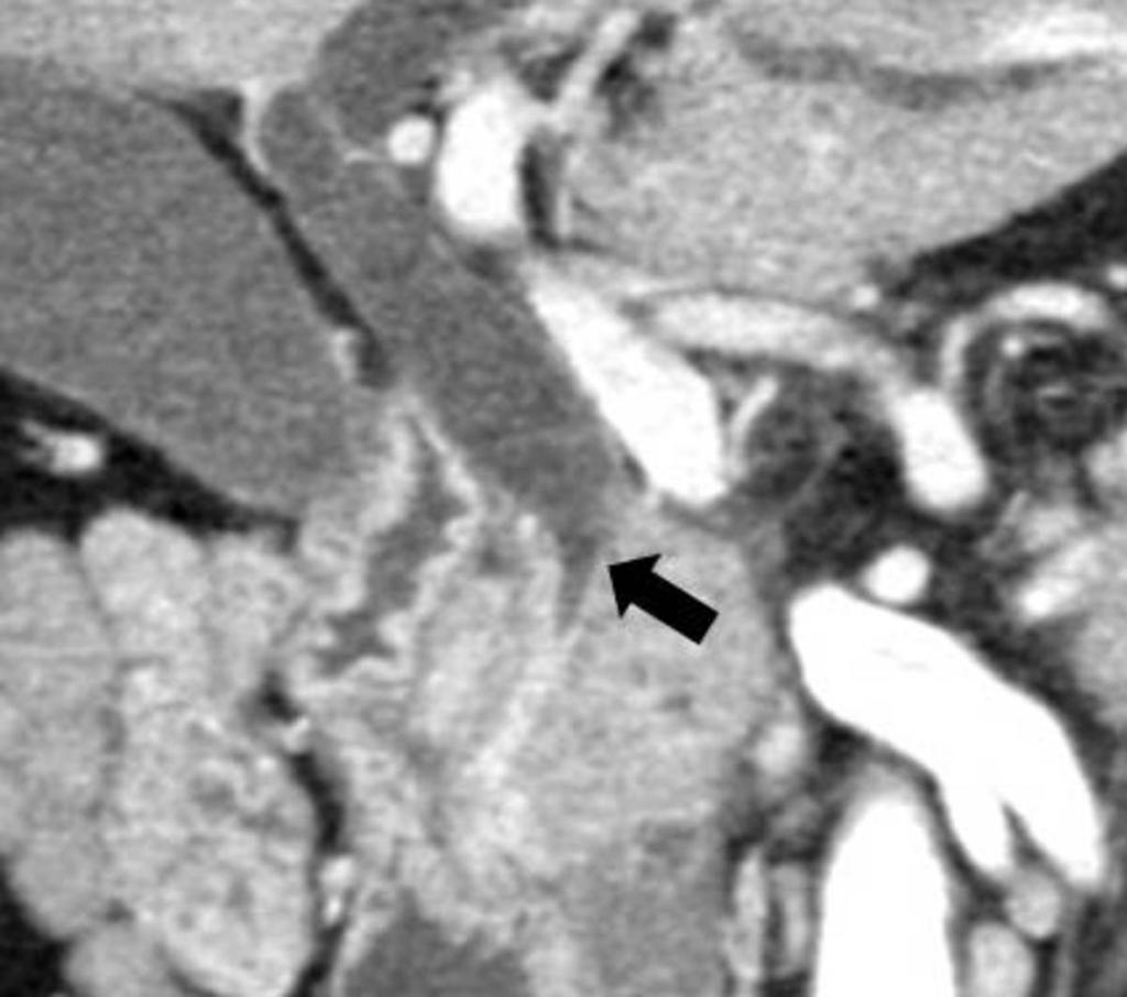 Fig. 1: A 59-year-old man with IgG4-SC.