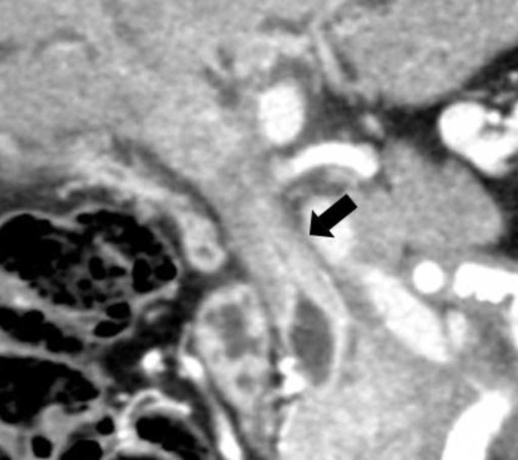 Fig. 2: A 70-year-old man with IgG4-SC.