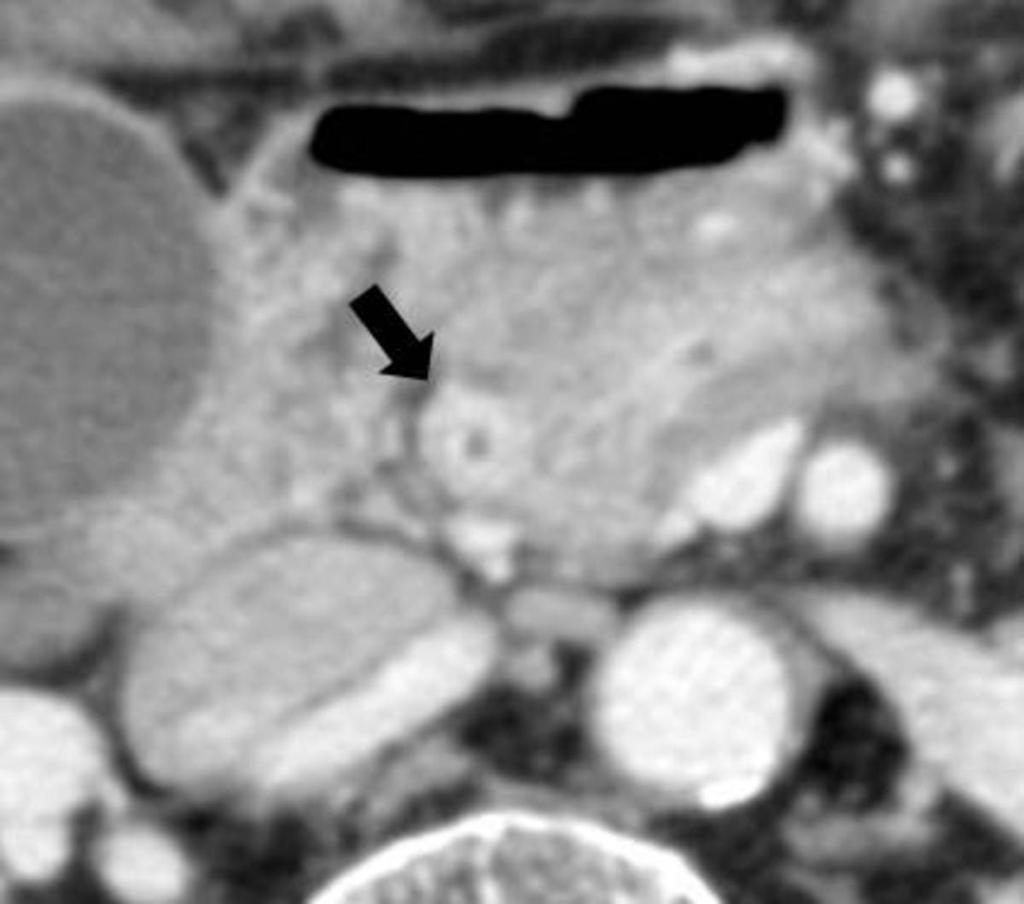 Fig. 3: A 74-year-old man with IgG4-SC.