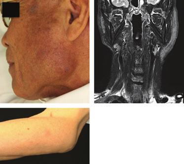 IgG4-related disease in pseudolymphoma (b) (a) Figure 1. There was itching subcutaneous nodules over a wide area from the left cheek to the mandible (a).