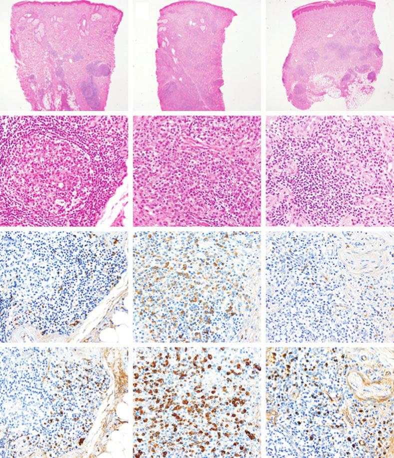 Y. Iwata et al. (a) (e) (i) (b) (f) (j) (c) (g) (l) (d) (h) (m) Figure 2. Histopathological examination of skin biopsy taken from the left face (a d), neck (e h) and right arm (i m).