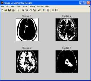 The ability of our proposed Brain Tumor Classification method is demonstrated on the basis of obtained results on Brain Tumor image database.