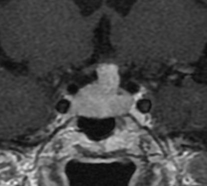 s MRI Pituitary lymphoma